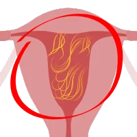 adherencias Especialista en Histeroscopia en Pachuca
