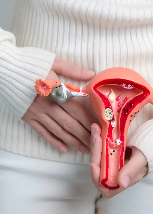 Especialista en Endometriosis en Pachuca