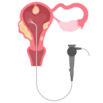 histeroscopia