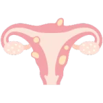 miomas