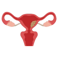 polipos endometriales Especialista en Histeroscopia en Pachuca