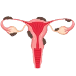 endometriosis